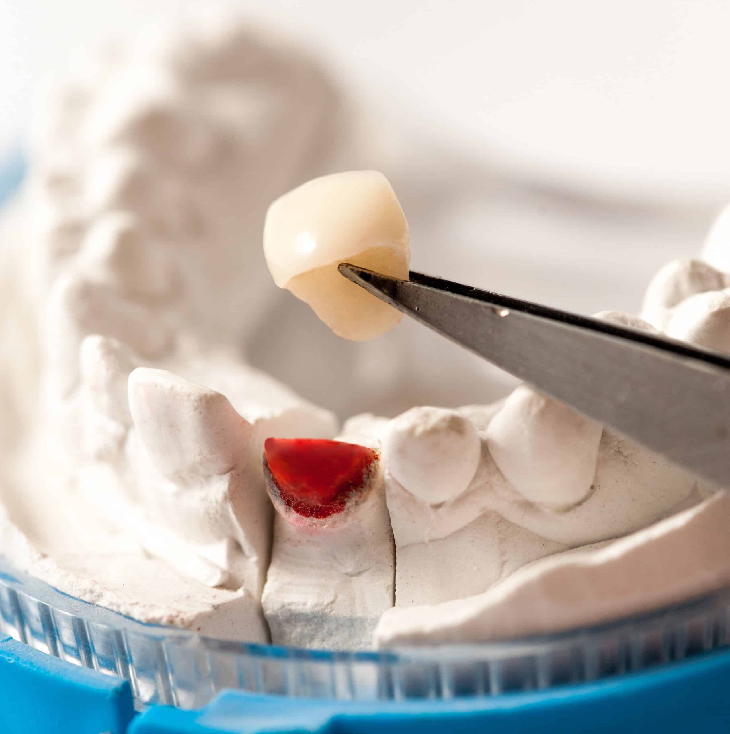 Dental Crowns Dallas